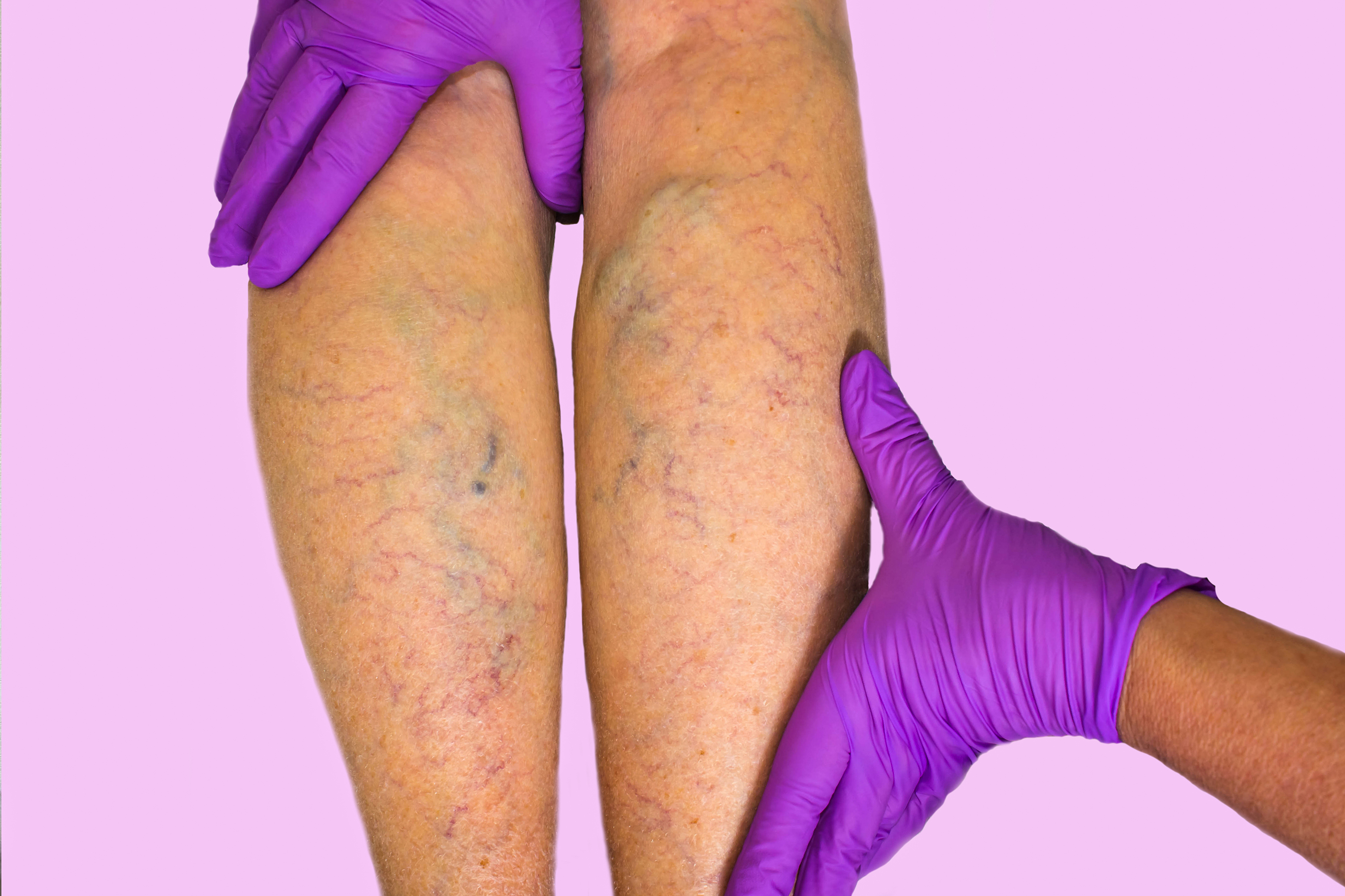 Varicose veins